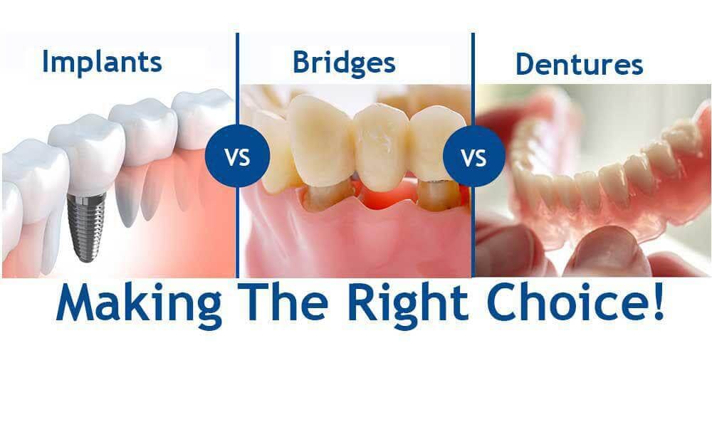 Options For Replacing Missing Teeth