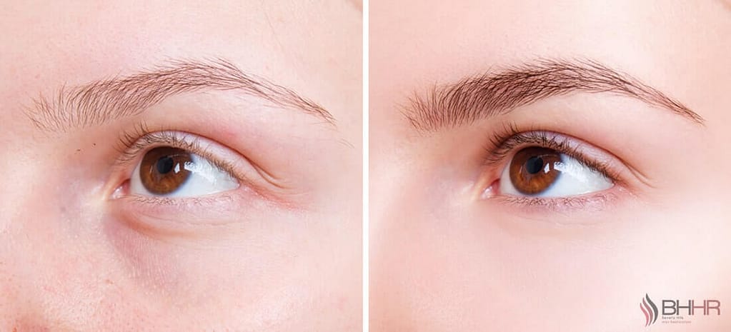 What is Eyebrow Restoration