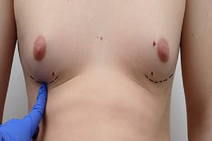 Gynecomastia Surgery UK