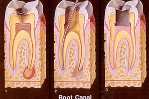root canal ottawa