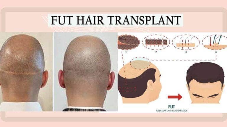 Facts About FUE Hair Transplant